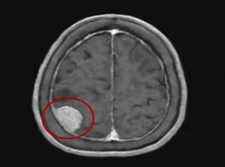 악성 뇌종양의 예시
