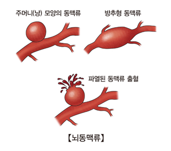 뇌동맥류-주머니(낭)모양의동맥류,방추형동맥류,파열된동맥류출혈 그림예시