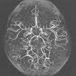 뇌혈관 조영술 사진