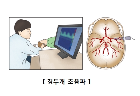 경두개 초음파를 받고 있는 남성과 뇌의 단면도