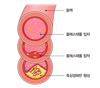 동맥 안 콜레스테롤입자,콜레스트롤침착,죽상경화반 형성 과정의 예시