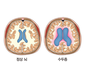 정상뇌와 수두증뇌 차이 그림 예시