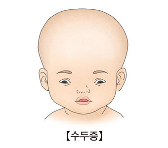 수두증-내압이 올라가 머리가 부어오른것처럼 보이는 신생아