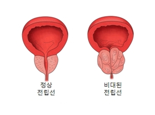 정상 전립선과 비대된 전립선 차이의 예시