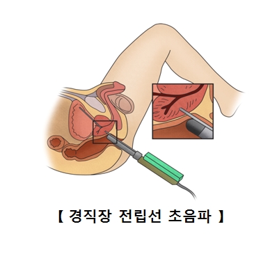 경직장 전립선 초음파 예시