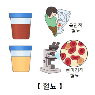 육안적,현미경적 혈뇨