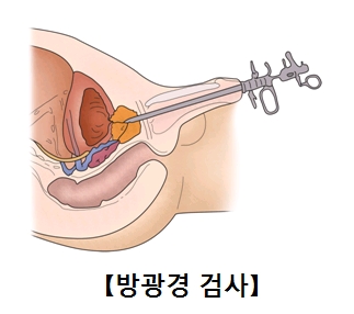 요도를 통해 방광 내시경을 삽입하는 방광경 검사의 예시