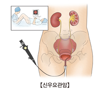 신우요관암의 여부를 확인하는 검사의 예시