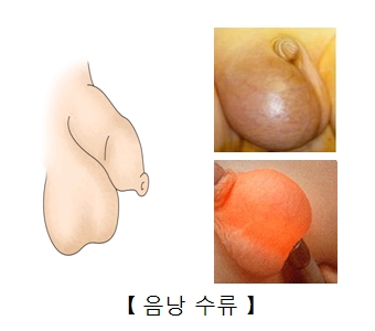 음낭수류 예시