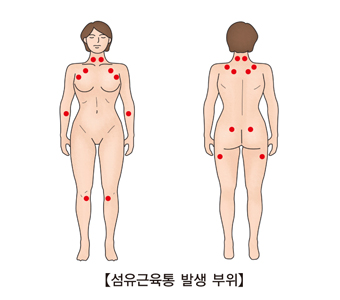 섬유근육통 발생 부위 예시