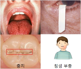 쇼그렌증후군 증상 거린 사람의 혓바닥 눈 충치 및 침샘부종의 예시