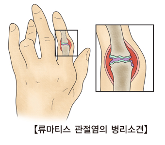 류마티스 관절염 병리소견