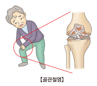 무릎통증을 호소하는 할아버지의 무릎 관절확대도