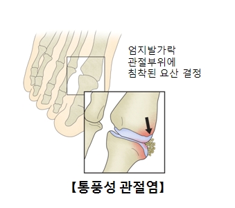  통풍성관전염으로 인해 엄지발가락 관절부위에 침착된 요산결정 사진