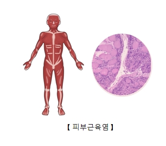 피부근육염의 예시