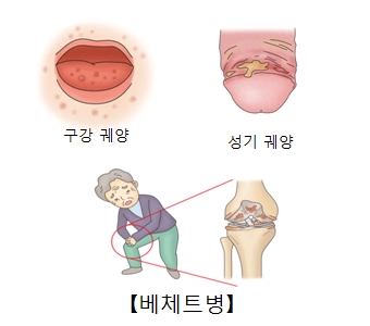 구강궤양 및 성기궤양으로 인해 베체트 병에 대한 예시