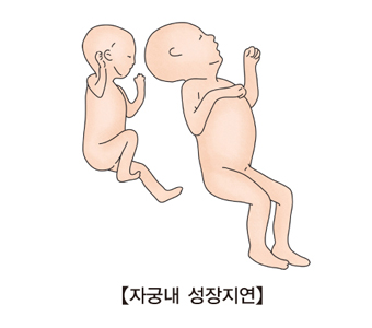 자궁내 성장지연의 대한 예시