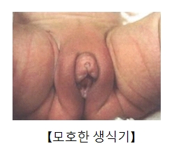 모호한 생식기의 예시