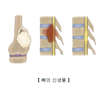 뼈의 신생물 예시