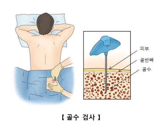 
피부 골반뼈 골수등 골수검사의 예시