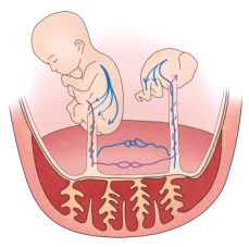 탯줄의 연결된 태아에게 신생아 다혈구증의 발생한 예시