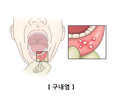 입술안쪽 구내염이 발생한 예시