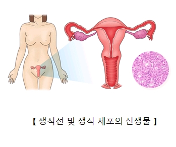 여성의 생식선 및 생식 세포의 신생물의 예시