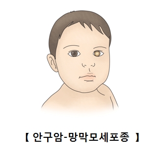 안구암 망막모세포종에 걸린 남자아이