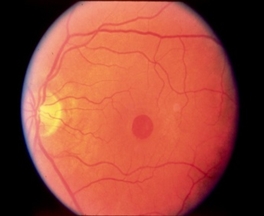 실제 망막의 중심부인 황반부의 중심에 망막조직의 결손이된 사진