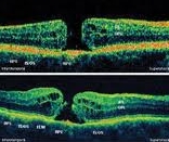 OCT검사로 나타난 황반부 천공