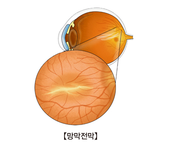 환반부 망막전막의 해부도 예시