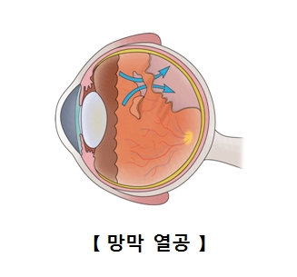 망막열공 사진 예시