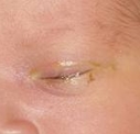 실제 비루관폐새증이 나타난 신생아의눈
