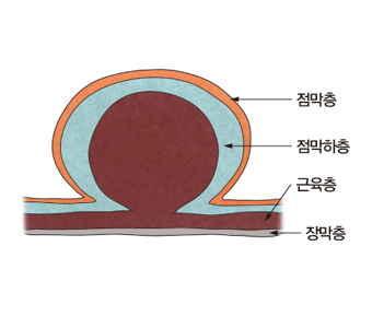 점막층 점막하층 근육층 장막층등 위장관 벽의 구조 예시