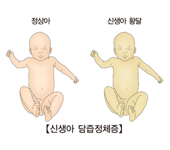 정상아와 황달이 발생한 신생아 황달의 차이점및 신생아 담즙정체증의 예시