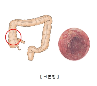 대장속 크론병의 예시