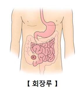 회장루의 예시