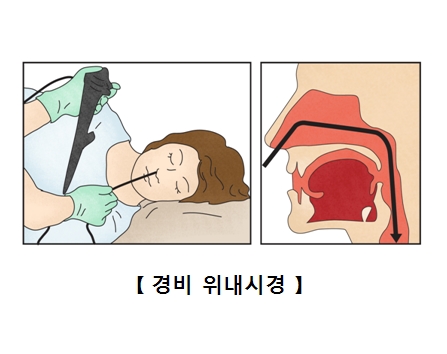 경비 위내시경을 받고 있는 여성