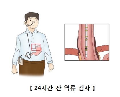 24시간 산 역류검사를 받구 있는 남성