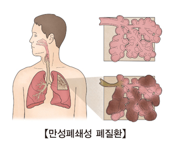 만성폐쇄성 폐질환의 예시