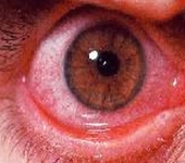 실제 알러지성 결막염이 발병된 눈