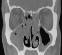 부비동 전산화 단층 촬영(CT 촬영) 사진 예시