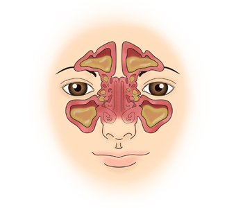 부비동안의 공간에 염증이 생긴 사진 예시