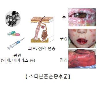 스티븐존슨증후군 원인(약제 바이러스 등)및 피부 점막 염증 및 눈 구강 전신에 일어난 스티븐존슨증후군 예시