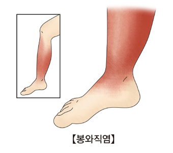 다리쪽 봉와직염의 예시