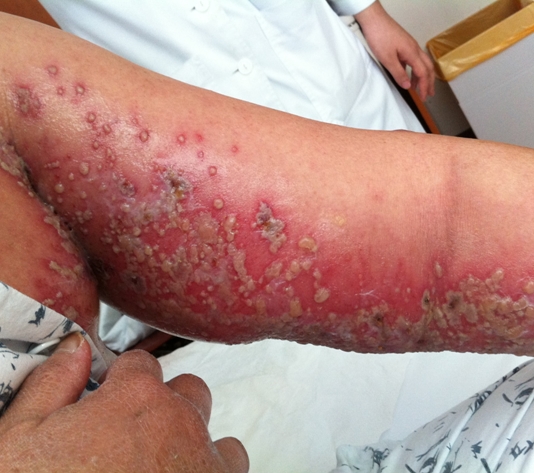 단순포진바이러스로인해 팔전체에 퍼진 피부염증와물집 사진