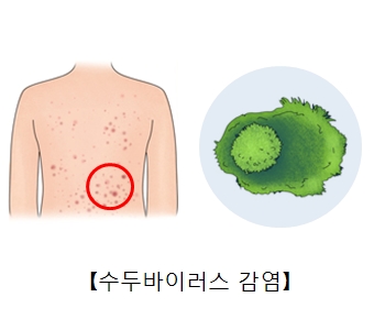 수두바이러스와 수두바이러스 감염으로 인한 대상포진의 예시