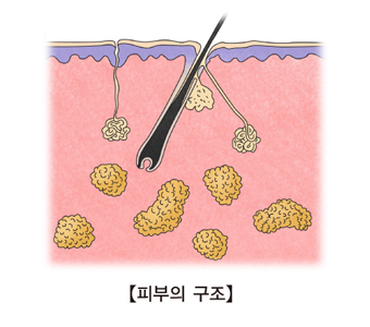 여드름이 생기는 피부의 구조 예시