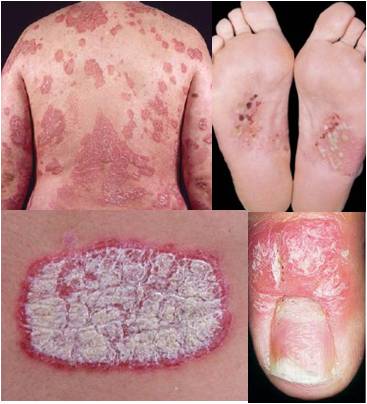 Примеры псориаза в нашем теле, такие как задние подошвенные пальцы ног