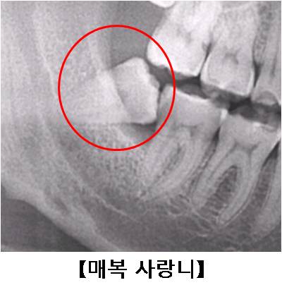 매복사랑니의 x-ray사진